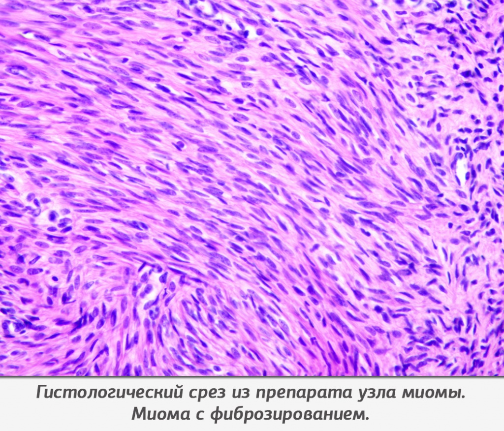 Гистологический срез из препарата узла миомы. Миома с фиброзированием.
